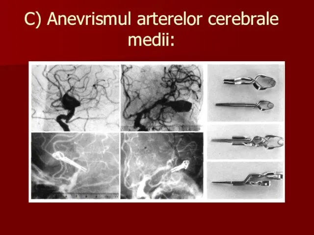 C) Anevrismul arterelor cerebrale medii: