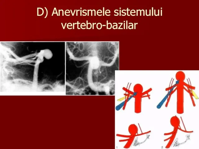 D) Anevrismele sistemului vertebro-bazilar