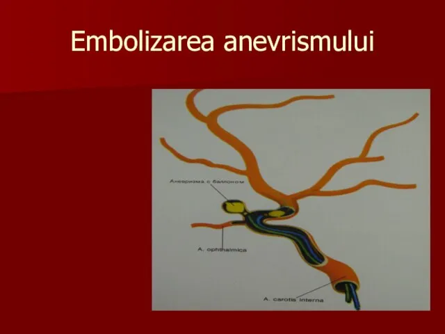 Embolizarea anevrismului