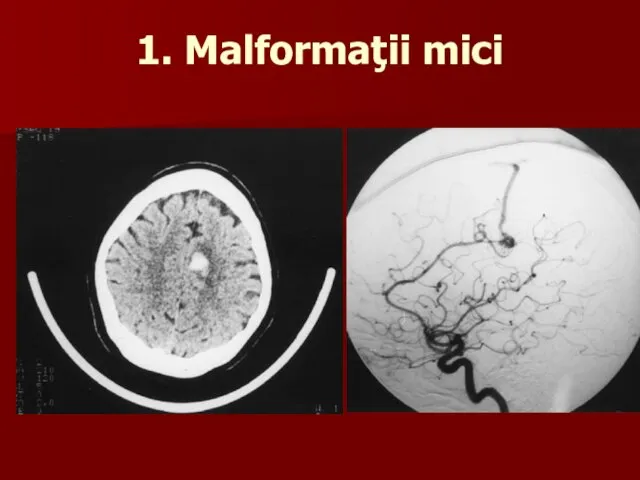 1. Malformaţii mici