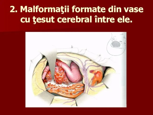 2. Malformaţii formate din vase cu ţesut cerebral între ele.