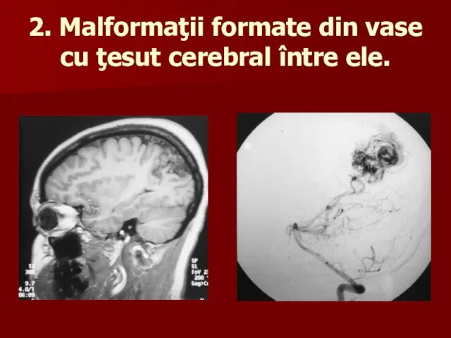 2. Malformaţii formate din vase cu ţesut cerebral între ele.