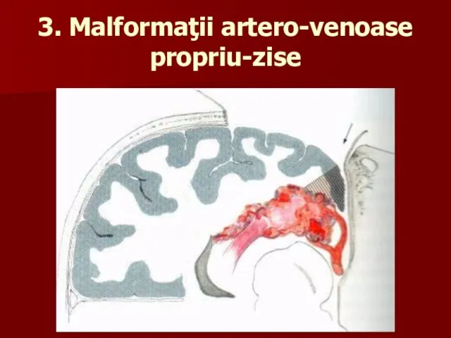 3. Malformaţii artero-venoase propriu-zise