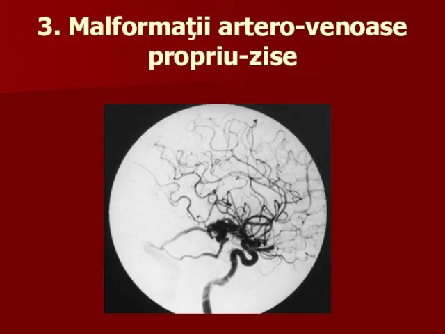 3. Malformaţii artero-venoase propriu-zise