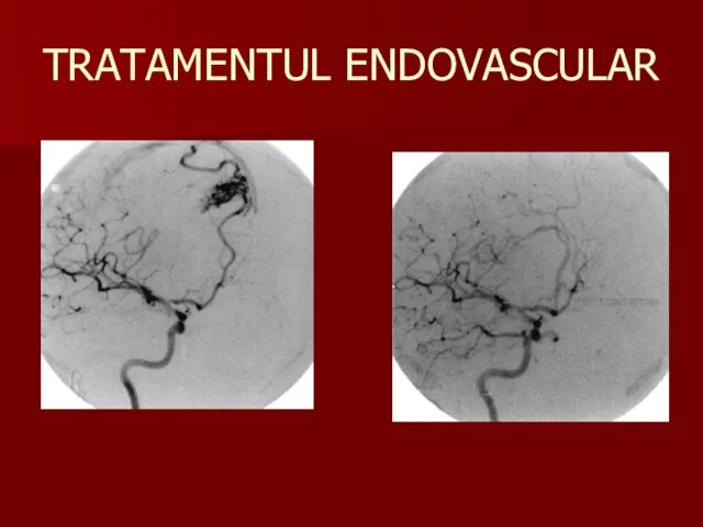 TRATAMENTUL ENDOVASCULAR