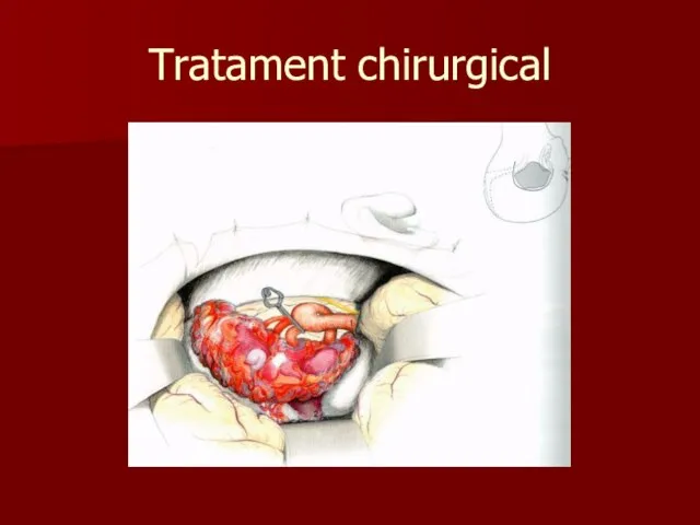 Tratament chirurgical