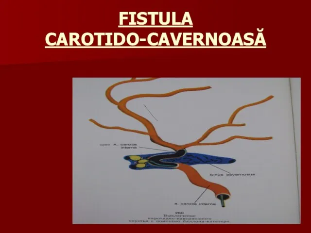 FISTULA CAROTIDO-CAVERNOASĂ
