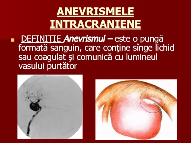 ANEVRISMELE INTRACRANIENE DEFINIŢIE Anevrismul – este o pungă formată sanguin, care