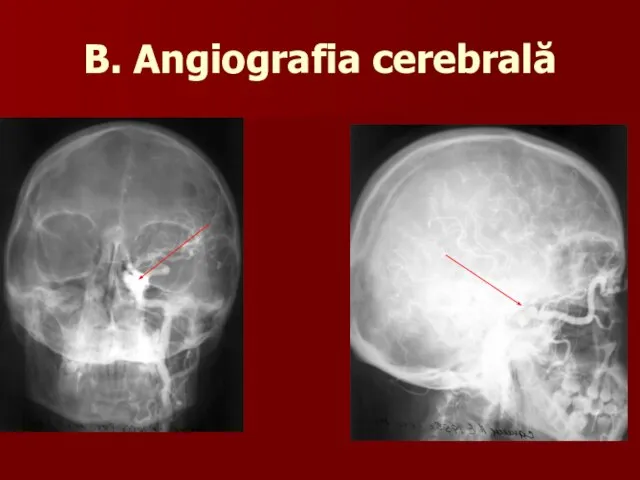 B. Angiografia cerebrală