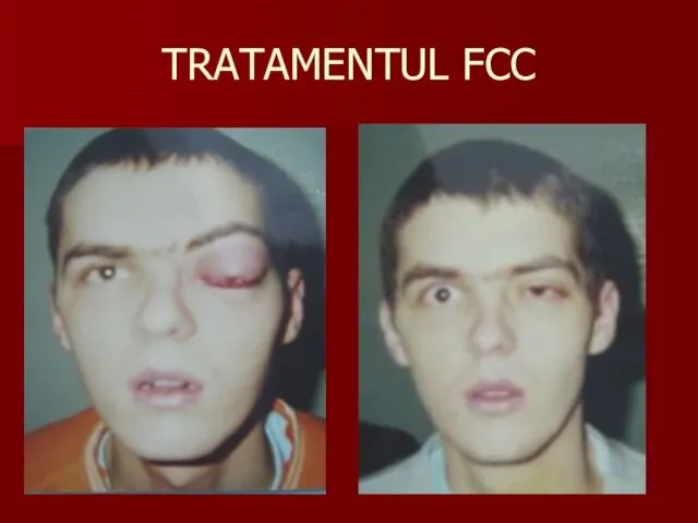 TRATAMENTUL FCC