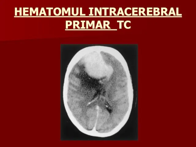 HEMATOMUL INTRACEREBRAL PRIMAR TC