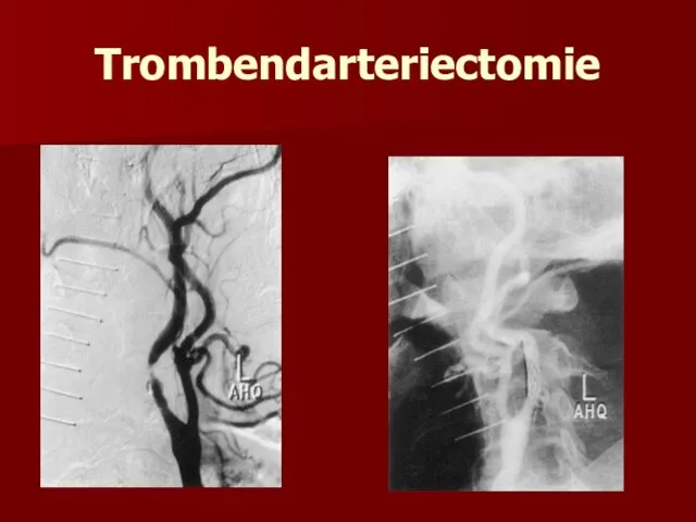 Trombendarteriectomie