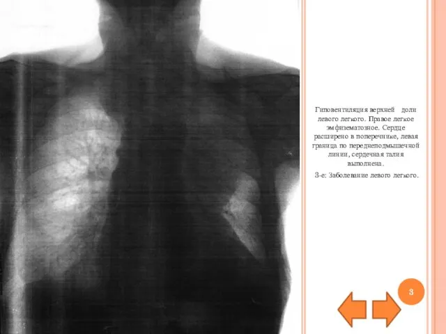 Гиповентиляция верхней доли левого легкого. Правое легкое эмфизематозное. Сердце расширено в