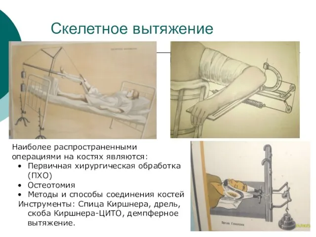 Скелетное вытяжение Наиболее распространенными операциями на костях являются: Первичная хирургическая обработка