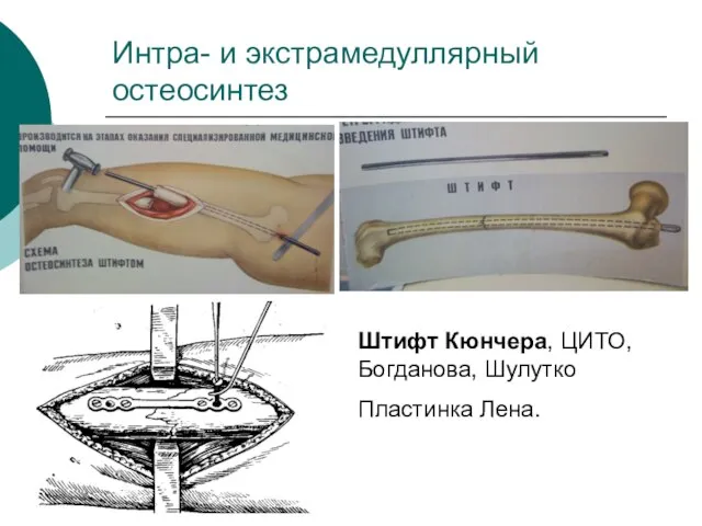 Интра- и экстрамедуллярный остеосинтез Штифт Кюнчера, ЦИТО, Богданова, Шулутко Пластинка Лена.