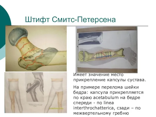 Штифт Смитс-Петерсена Имеет значение место прикрепление капсулы сустава. На примере перелома