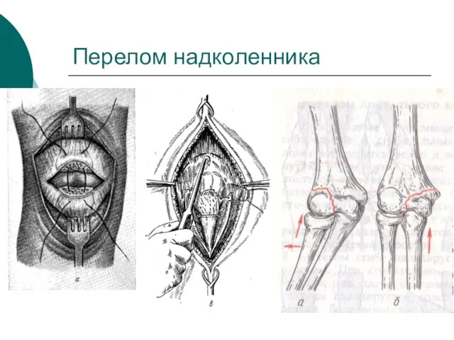 Перелом надколенника