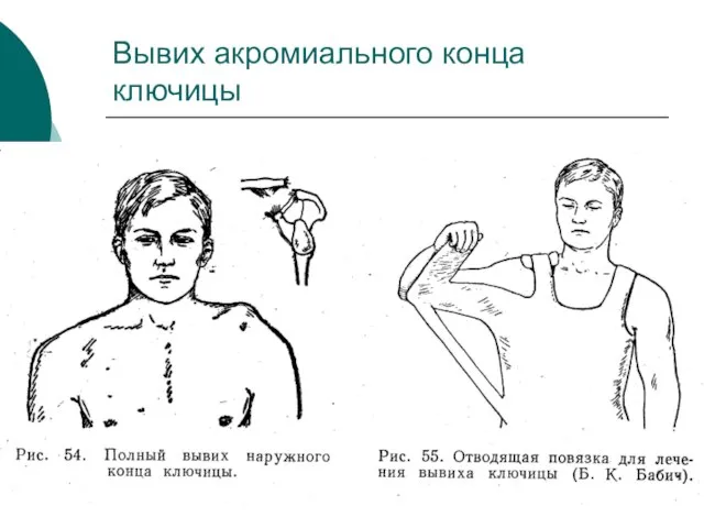 Вывих акромиального конца ключицы