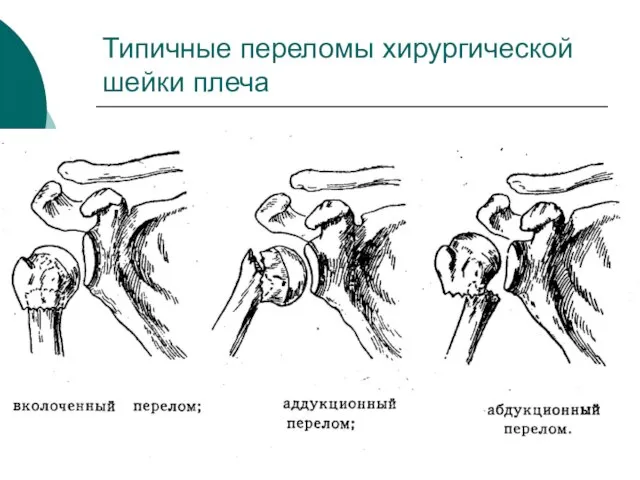 Типичные переломы хирургической шейки плеча