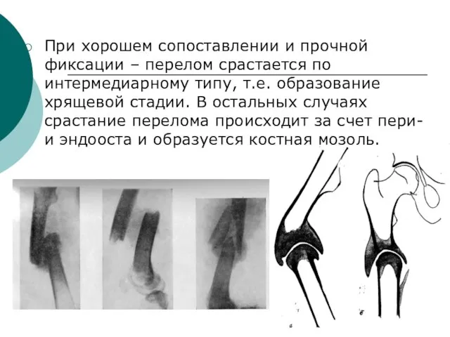 При хорошем сопоставлении и прочной фиксации – перелом срастается по интермедиарному