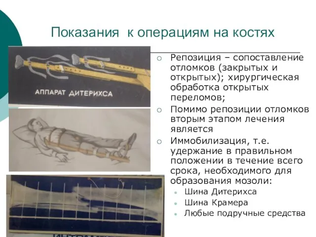 Показания к операциям на костях Репозиция – сопоставление отломков (закрытых и