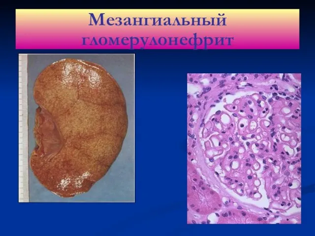 Мезангиальный гломерулонефрит