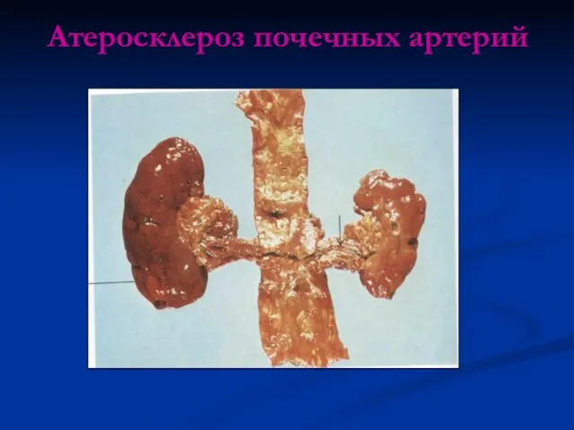 Атеросклероз почечных артерий