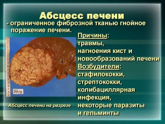 Абсцесс печени