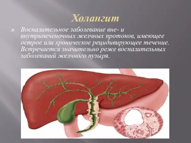 Холангит Воспалительное заболевание вне- и внутрипеченочных желчных протоков, имеющее острое или
