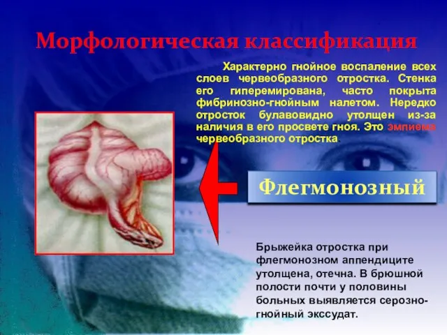 Морфологическая классификация Флегмонозный Характерно гнойное воспаление всех слоев червеобразного отростка. Стенка