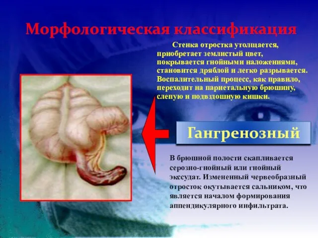 Морфологическая классификация Гангренозный Стенка отростка утолщается, приобретает землистый цвет, покрывается гнойными