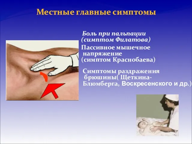 Боль при пальпации (симптом Филатова) Пассивное мышечное напряжение (симптом Краснобаева) Местные