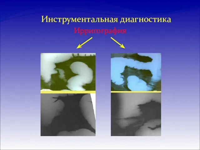 Инструментальная диагностика Ирригография