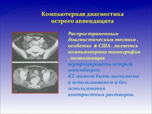 Компьютерная диагностика острого аппендицита Распространенным диагностическим тестом , особенно в США