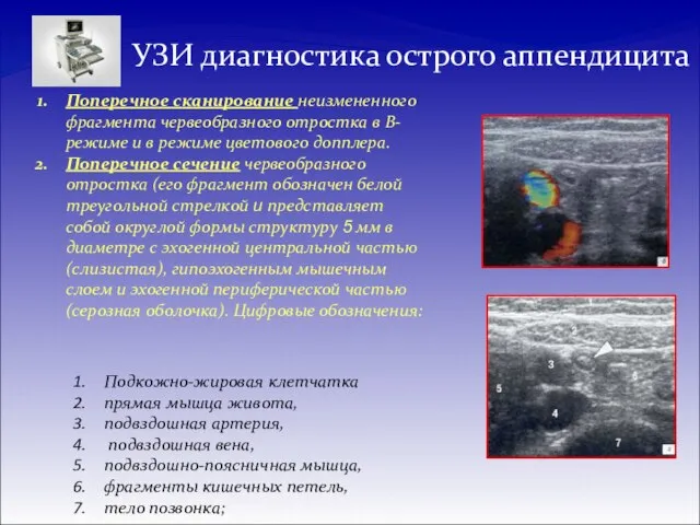 УЗИ диагностика острого аппендицита Поперечное сканирование неизмененного фрагмента червеобразного отростка в