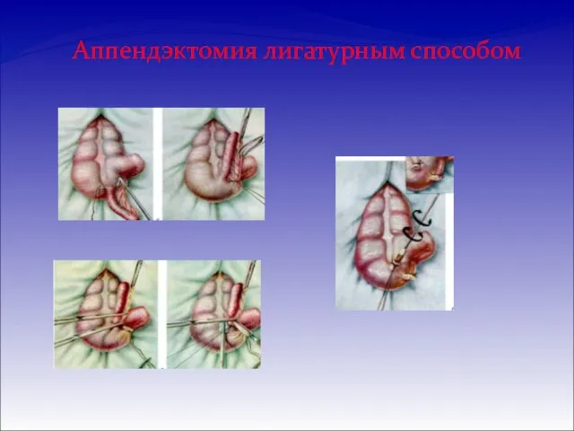 Аппендэктомия лигатурным способом