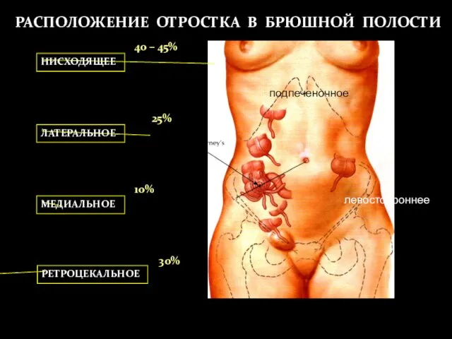 РАСПОЛОЖЕНИЕ ОТРОСТКА НИСХОДЯЩЕЕ 40 – 45% ЛАТЕРАЛЬНОЕ 25% МЕДИАЛЬНОЕ 10% РЕТРОЦЕКАЛЬНОЕ