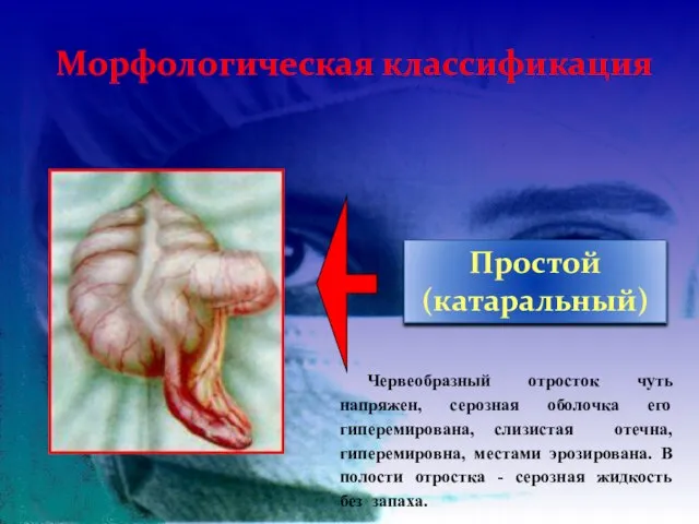 Морфологическая классификация Простой (катаральный) Червеобразный отросток чуть напряжен, серозная оболочка его