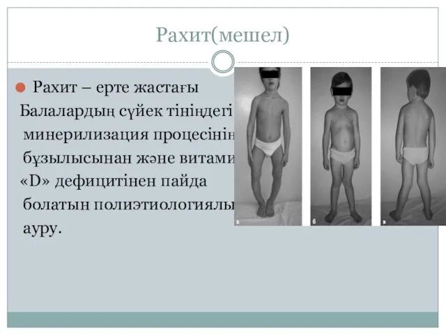 Рахит(мешел) Рахит – ерте жастағы Балалардың сүйек тініңдегі минерилизация процесінің бұзылысынан