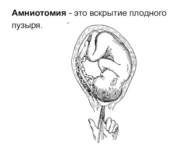 Амниотомия - это вскрытие плодного пузыря.