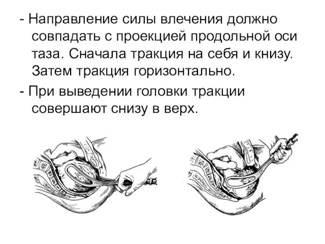 - Направление силы влечения должно совпадать с проекцией продольной оси таза.