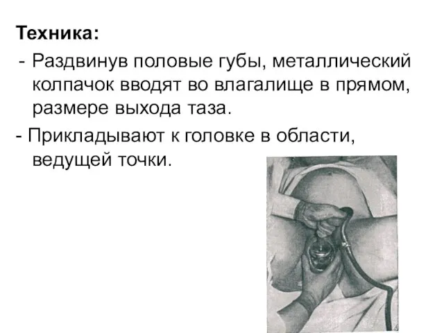 Техника: Раздвинув половые губы, металлический колпачок вводят во влагалище в прямом,