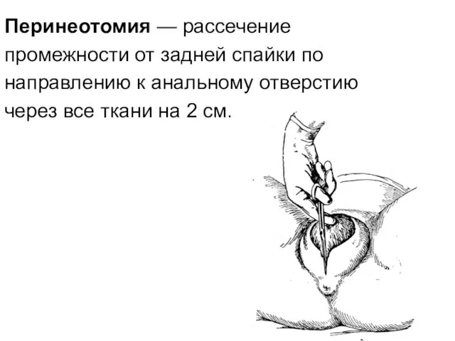 Перинеотомия — рассечение промежности от задней спайки по направлению к анальному