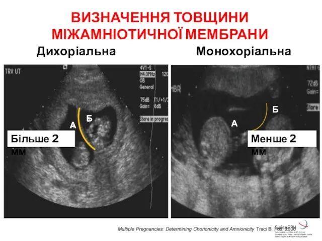 ВИЗНАЧЕННЯ ТОВЩИНИ МІЖАМНІОТИЧНОЇ МЕМБРАНИ Дихоріальна Монохоріальна Більше 2 мм Менше 2 мм Б А Б А