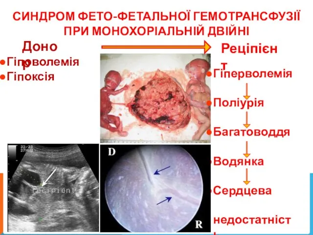 СИНДРОМ ФЕТО-ФЕТАЛЬНОЇ ГЕМОТРАНСФУЗІЇ ПРИ МОНОХОРІАЛЬНІЙ ДВІЙНІ Донор Реціпієнт Гіповолемія Гіпоксія Гіперволемія Поліурія Багатоводдя Водянка Сердцева недостатність