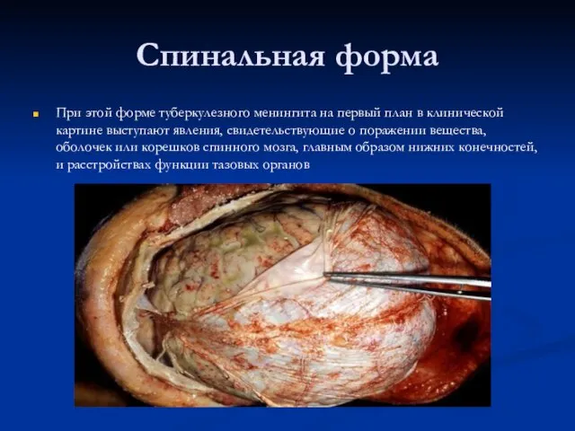 Спинальная форма При этой форме туберкулезного менингита на первый план в