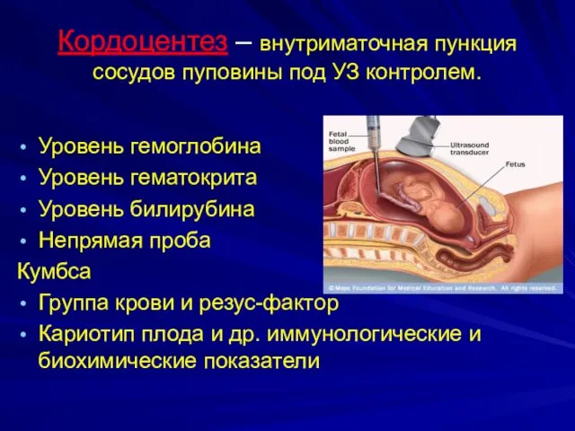 Кордоцентез – внутриматочная пункция сосудов пуповины под УЗ контролем. Уровень гемоглобина