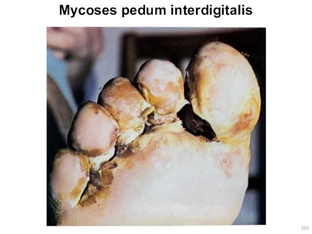 Mycoses pedum interdigitalis