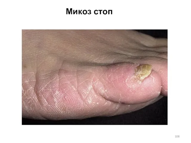 Микоз стоп