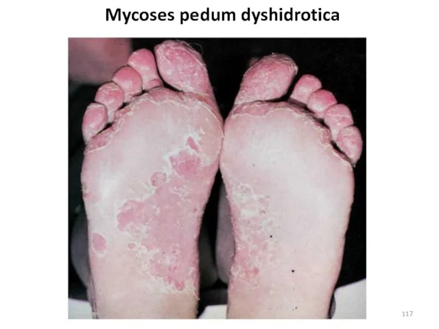 Mycoses pedum dyshidrotica